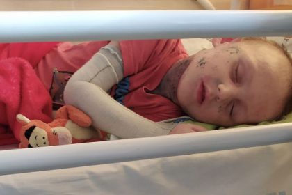 Lekari si dlho mysleli ze ide o ekzem Pribeh chlapca so zriedkavym syndromom vs dojme